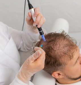 topical stem cell treatment for hair loss