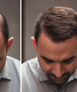 topical stem cell treatment for hair loss