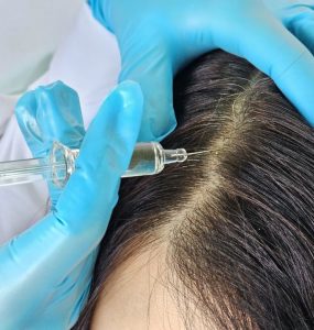 topical stem cell treatment for hair loss