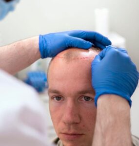 alopecia stem cell treatment