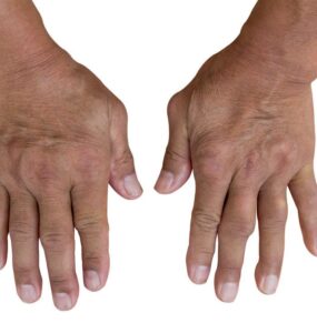 stem cells rheumatoid arthritis treatment