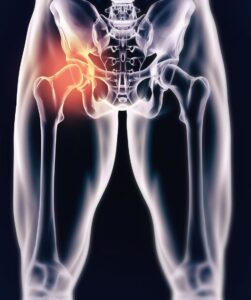 After Hip Stem Cell Treatment