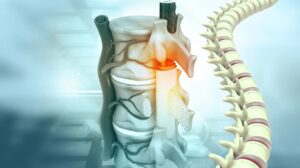 Spinal Stenosis Treatment