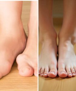 stem cell treatment for gout