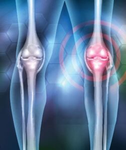 Chondromalacia Stem Cell Treatment
