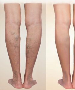 Stem Cell Treatment for Neuropathy