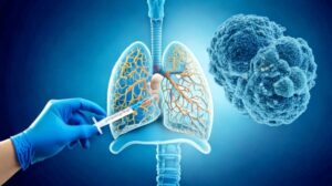 Stem Cell Treatment For Emphysema