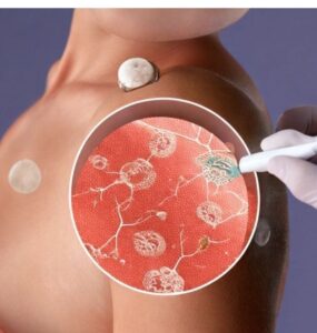 stem cell treatment for lichen sclerosus