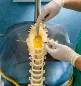 stem cell treatment for lumbar disc repair
