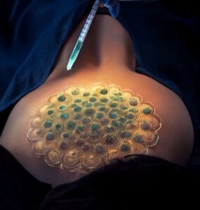 osteopetrosis stem cell treatment