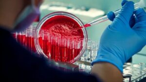 sickle cell stem cell treatment