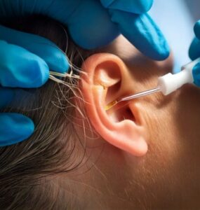 Stem Cell Treatment for Ear Nerve Damage