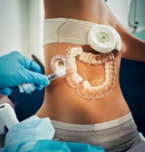 stem cell treatment for ulcerative colitis