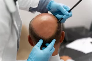 Regencord Stem Cell Treatment for Baldness